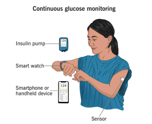 Continuous Glucose Monitoring Device